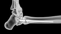 Clou de fibula, Vue 1