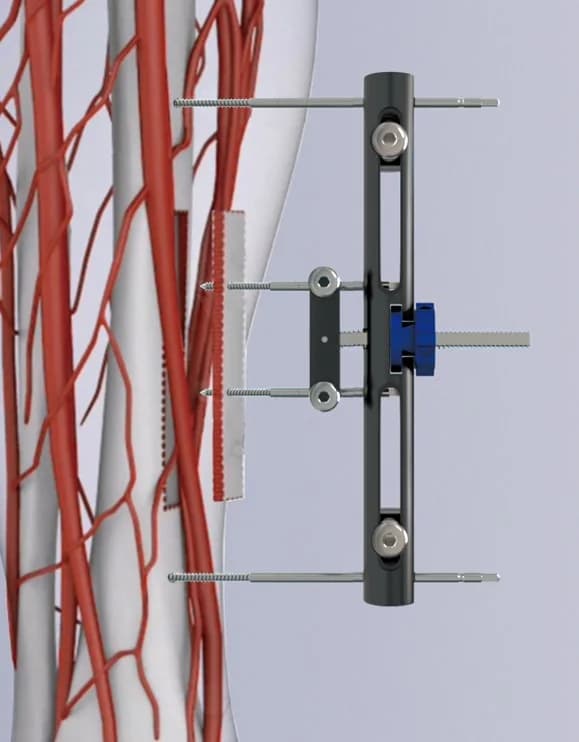 TTT System